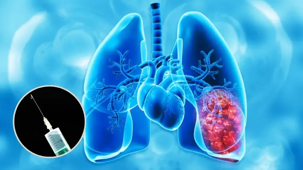 Inician en el mundo ensayos clínicos de vacuna de ARN mensajero contra cáncer de pulmón