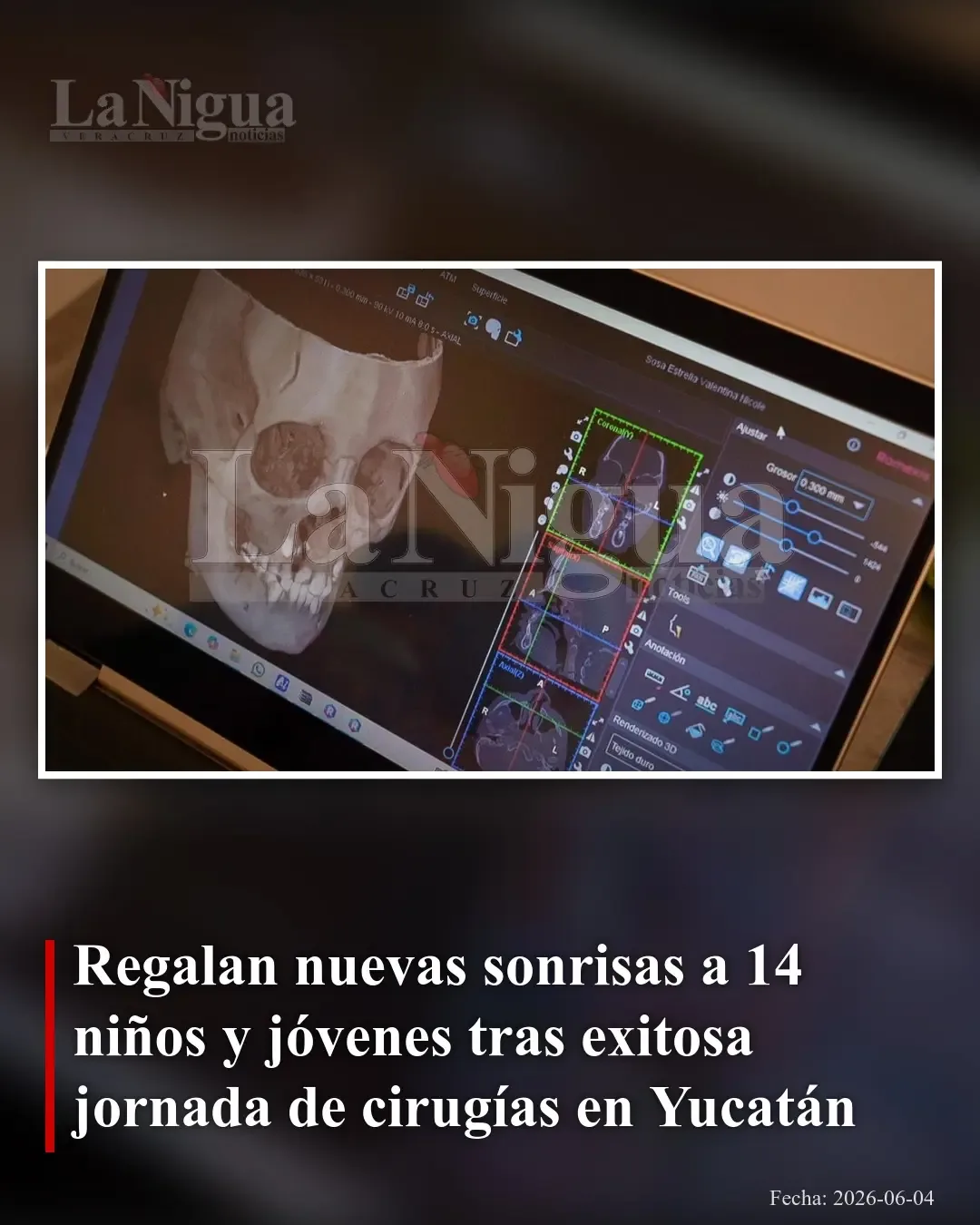 Jornada quirúrgica en Yucatán transforma la vida de 14 pacientes con labio y paladar hendido