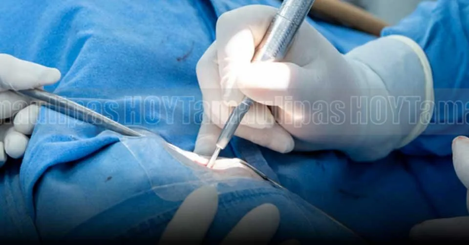 Primer implante coclear bilateral en niña de tres años realizado en Hospital Juárez